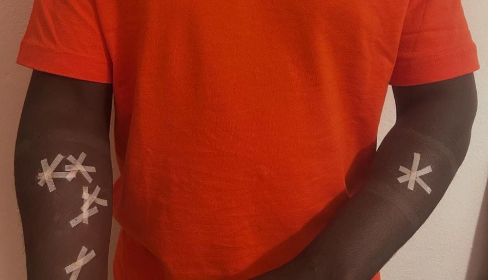 Puntos de sutura en los brazos de una víctima de una agresión racista en Camas (Sevilla). Foto: lavozdelsur.es