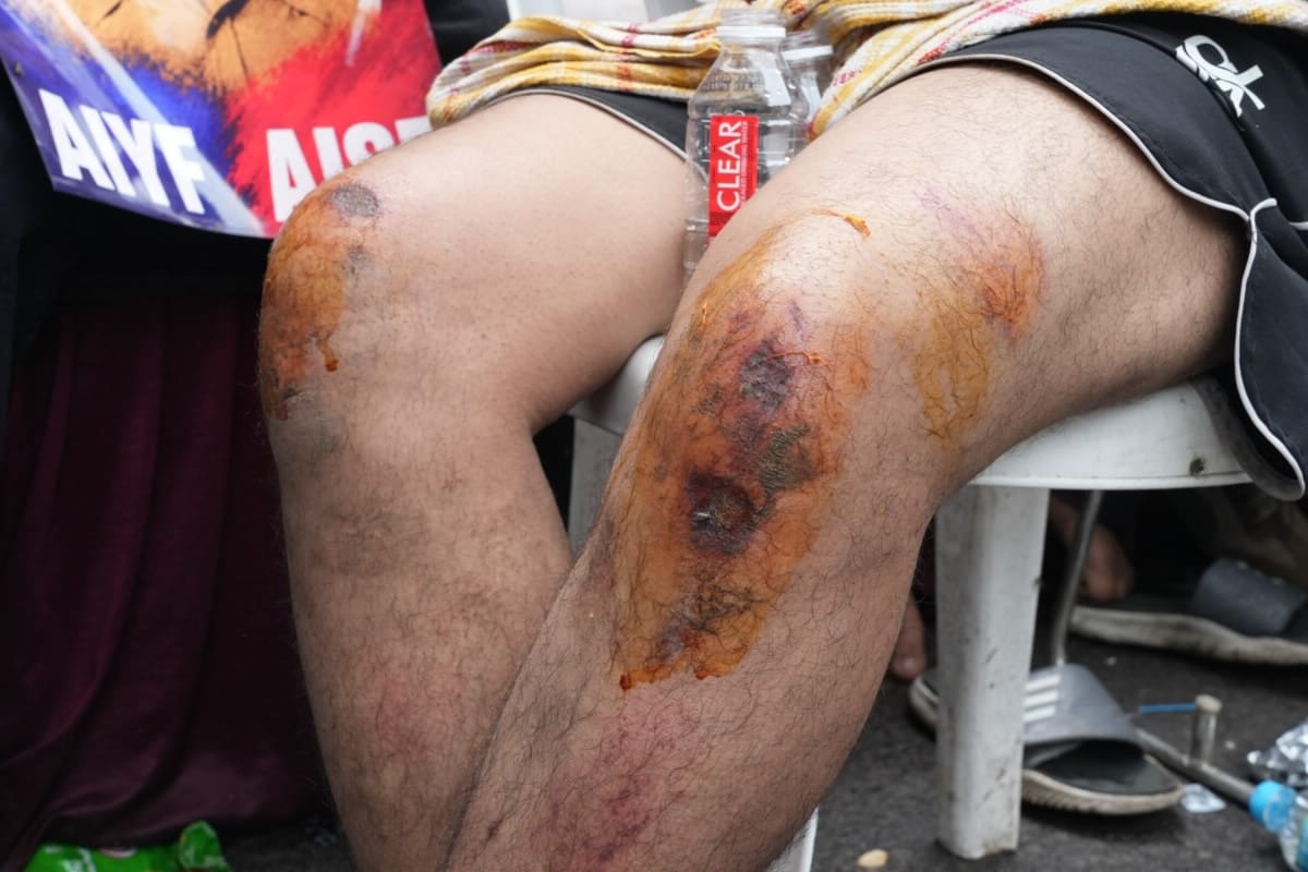 Jóven herido por la represión policial el 20 de julio. Foto: Suhail Bhat