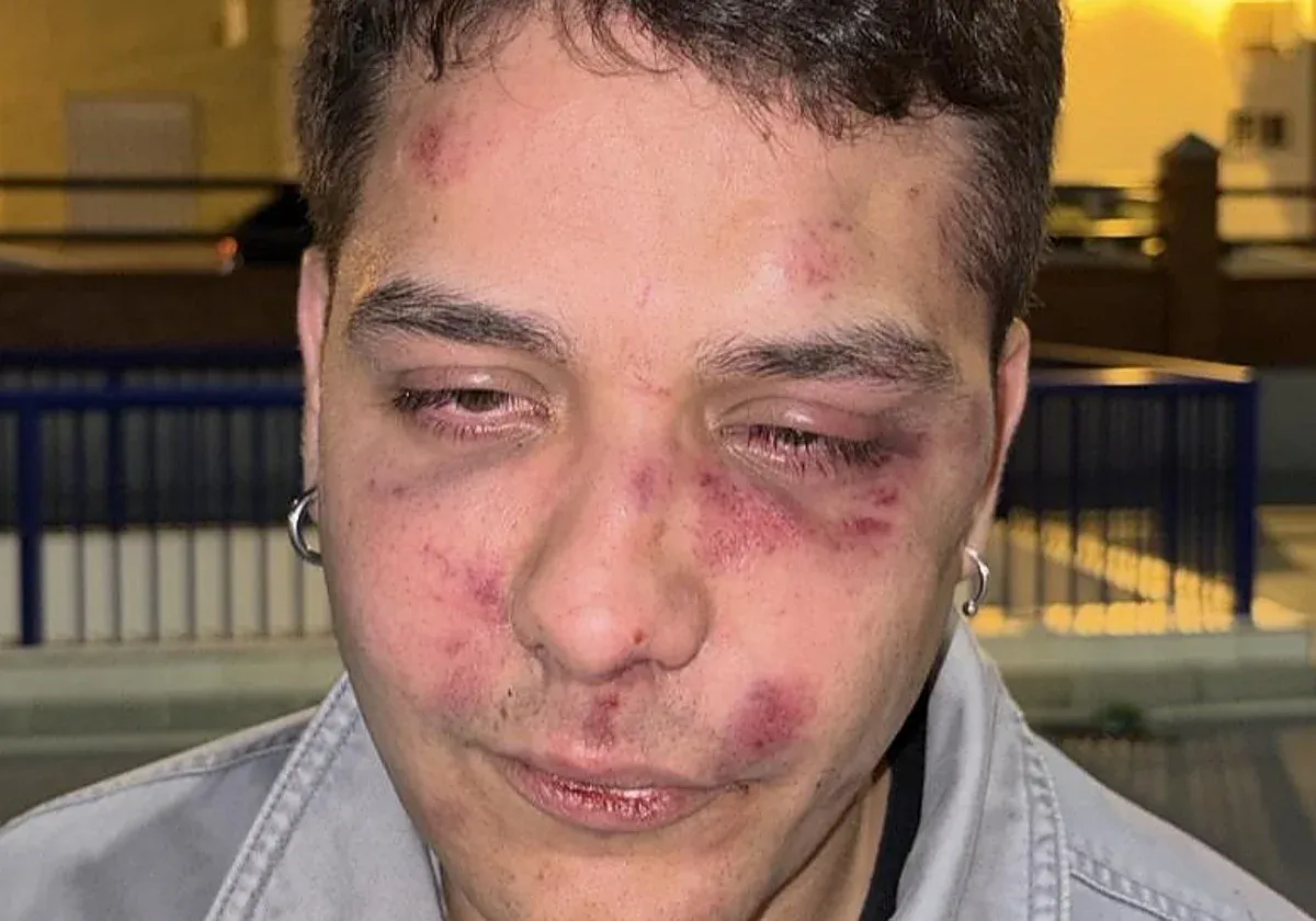 Pablo Romero, joven agredido en Málaga por dos fascistas. Foto: Pablo Romero