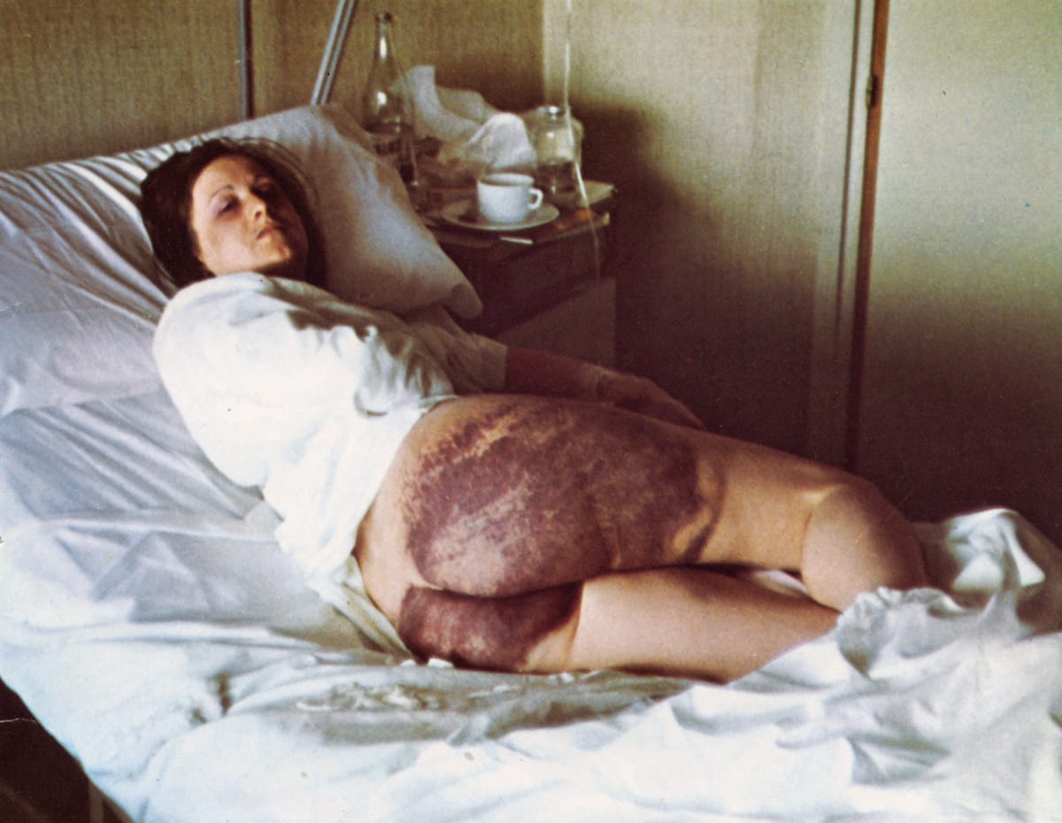 Amparo Arangoa con heridas hematomas visibles tras las torturas sufridas en comisaría a finales de abril de 1976. Foto: Javier Yaben/Argia