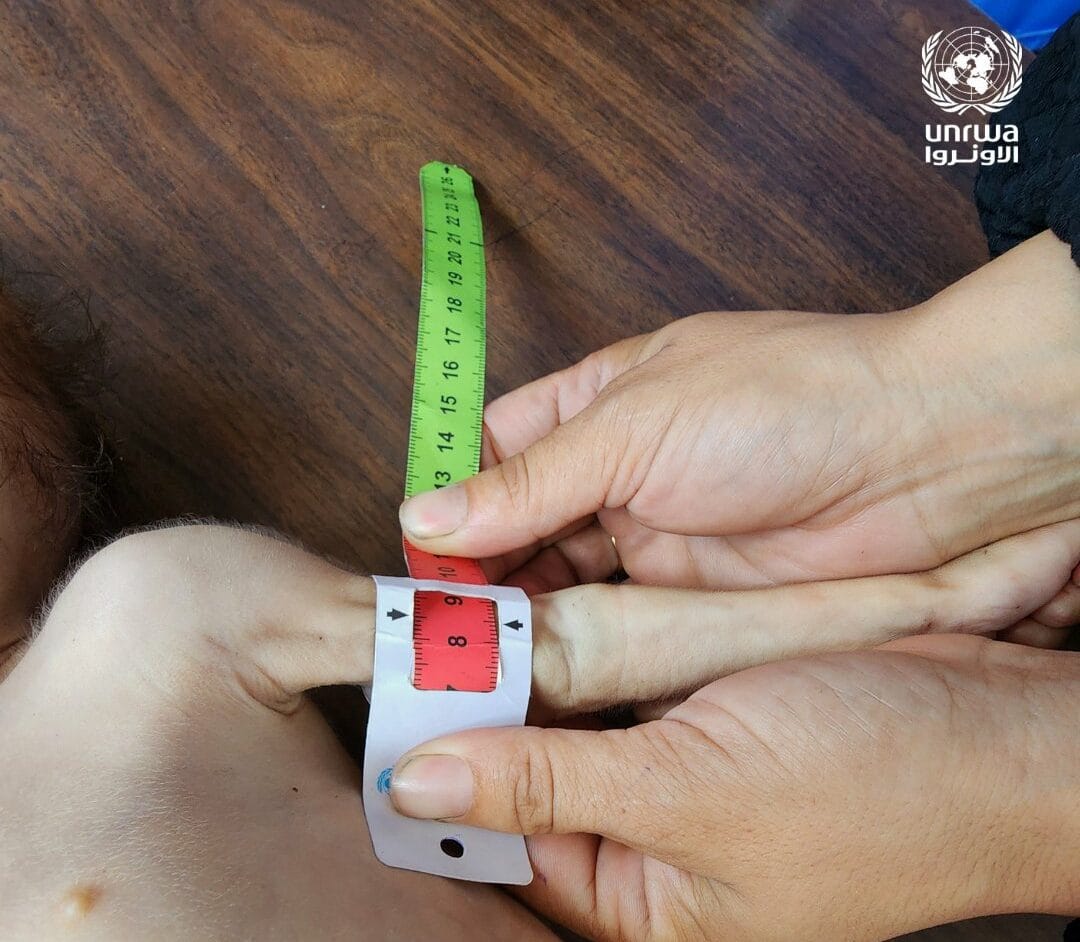 La ONU alerta de que uno de cada diez niños examinados en Gaza padece malnutrición